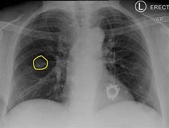 Image result for Pulmonary Nodule X-ray