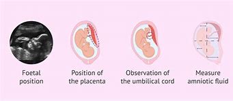 Image result for Third-Trimester Sirenomelia