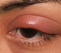 Image result for eyelid