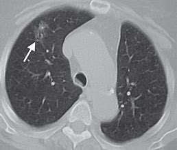 Image result for 2 Cm Nodule On Lung