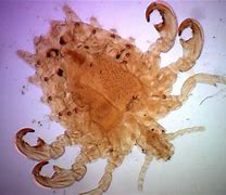 Image result for Crab Lice Treatment