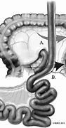 Image result for Jejunum Hernia