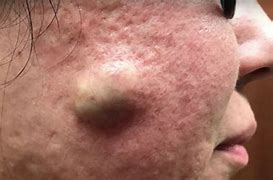 Image result for Cystic Acne Pimple Popping