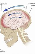 Image result for Back of Head Injury Concussion