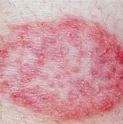Image result for Metformin Allergy Rash