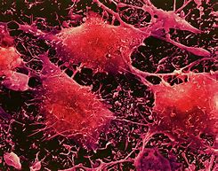 Image result for Brain Cancer Cells