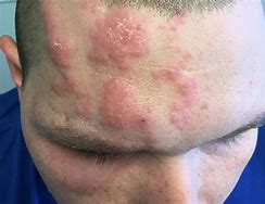 Image result for Rash On Forehead