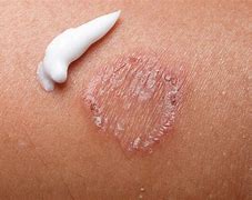 Image result for 10 Common Skin Cancer Rash