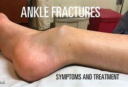 Image result for Broken Ankle Fracture