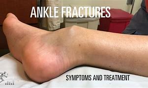 Image result for Female Broken Ankle