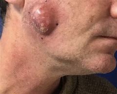 Image result for Sebaceous Cyst On Face