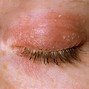 Image result for What Causes Eczema around Eyes