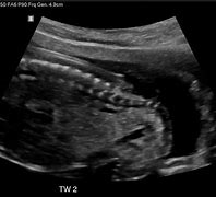 Image result for Neural Tube Defect Ultrasound