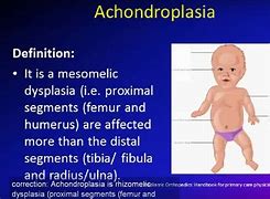 Image result for aconxroplasia