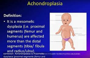 Image result for acondrool�sico