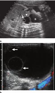 Image result for Ovarian Cyst Radiology