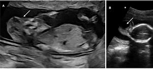 Image result for Anencephaly On Ultrasound