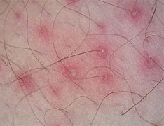 Image result for Bacterial Folliculitis