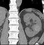 Image result for Renal Cyst CT Scan