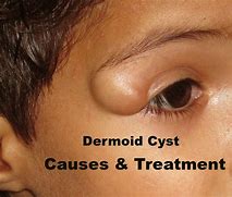 Image result for Dermoid Cyst Symptoms