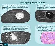 Image result for How Big Is 4 Cm Tumor