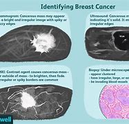 Image result for How Big Is 8Mm Tumor