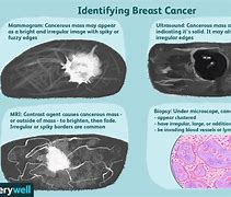 Image result for How Large Is 8Mm Tumor
