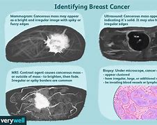 Image result for Cancer Tumor 6 mm How Big