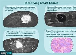 Image result for How Big Is 8 Cm Tumor