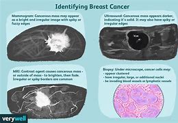 Image result for Cancerous Tumor