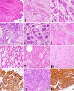 Image result for Viral Papilloma