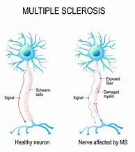 Image result for Multiple Sclerosis Brain