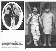 Image result for Lissencephaly with Cerebellar Hypoplasia