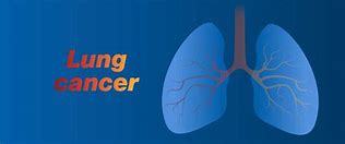 Image result for Small Cell Lung Cancer