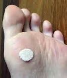 Image result for Treatment for Skin Warts