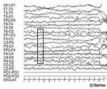 Image result for EEG Occipital Spikes