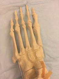 Image result for Jones Fracture