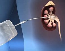Image result for Nephrostomy Tube Placement