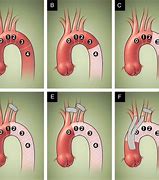 Image result for Ascending Aortic Stent Graft