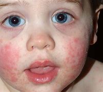 Image result for Childhood Skin Rashes