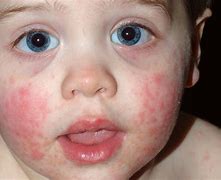 Image result for Fifth Disease in Children