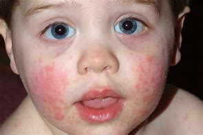 Image result for Pediatric Pustular Rash