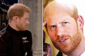 Image result for Prince Harry Hairline