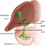 Image result for Bile Duct Tumor