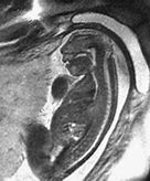 Image result for Anencephaly CT