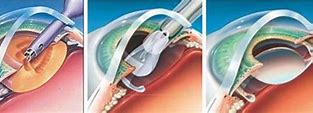 Image result for Phacoemulsification Cataract Surgery