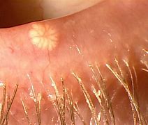 Image result for Molluscum Contagiosum around Eye