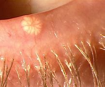 Image result for Molluscum Contagiosum Treatment Eye Lids
