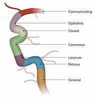 Image result for Cavernous Carotid Artery