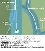 Image result for Venous Access Apheresis